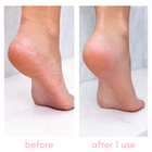 Kiara Sky -  Heel-ing Callus Remover Kit
